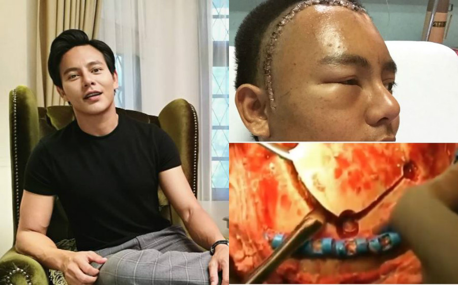 Dedah Video Bedah Otak, Peminat Syukur Nazim Othman ...