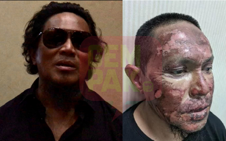Berdebar Bila Nampak Api - Ali XPDC Semakin Pulih Dari Melecur, Lebih Berhati-Hati Bila Bakar Sampah