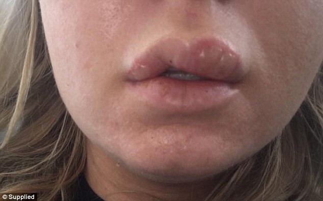 Supplied This is an actual photo of someone who used a fake Kylie Jenner lip kit.