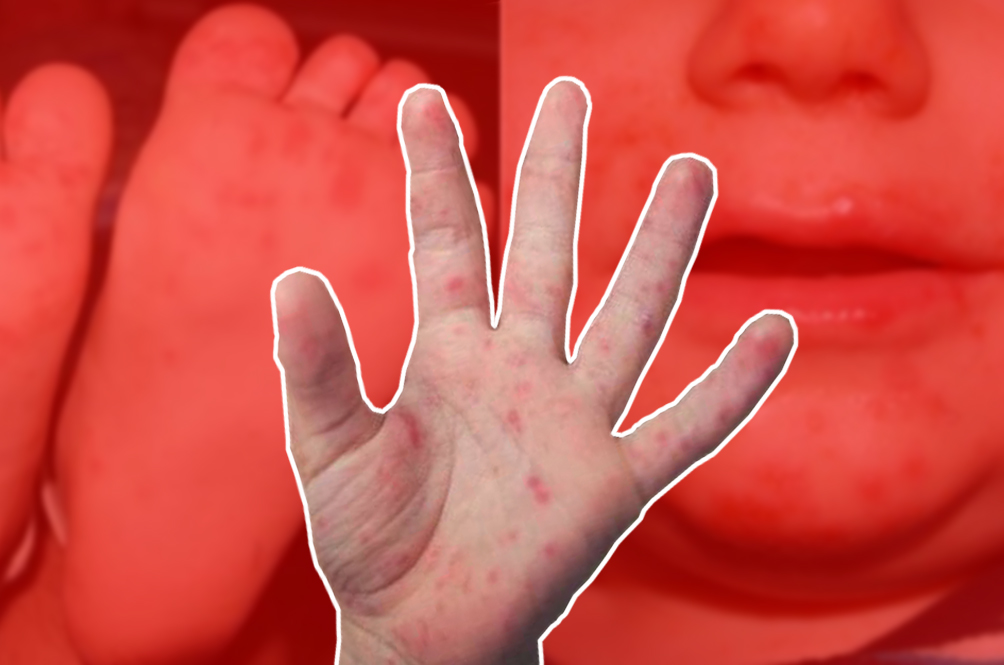 Debunking The Myths Surrounding The Hand, Foot And Mouth Disease (HFMD) | Lifestyle | Rojak Daily Debunking The Myths Surrounding The Hand, Foot And Mouth Disease (HFMD) | Lifestyle | Rojak Daily