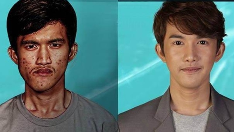 泰男天生脸部畸形 赴韩国整容变帅哥与变性女友相守 Xuan