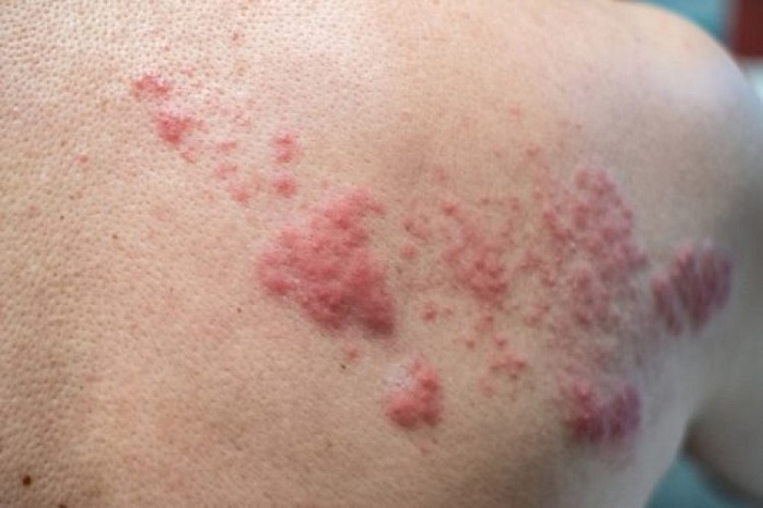 Tips I 蔡一杰经历 生蛇 痛得没命 带状疱疹4种止痛止痒舒缓方式 Xuan
